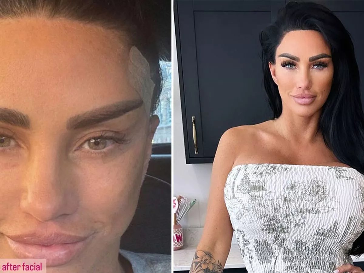 Katie Price Looks UNRECOGNIZABLE After Getting More Cosmetic Work Done Weeks After Major Facelift