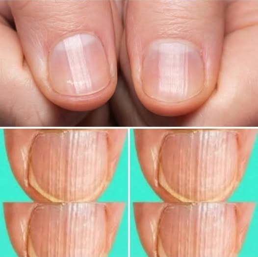Rippled Fingernails: What They Might Tell You About Your Health